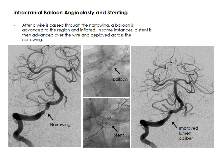 Intracranial Balloon Angioplasty and Stenting