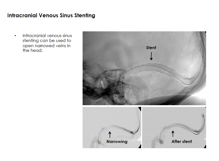 Intracranial Venous Sinus Stenting