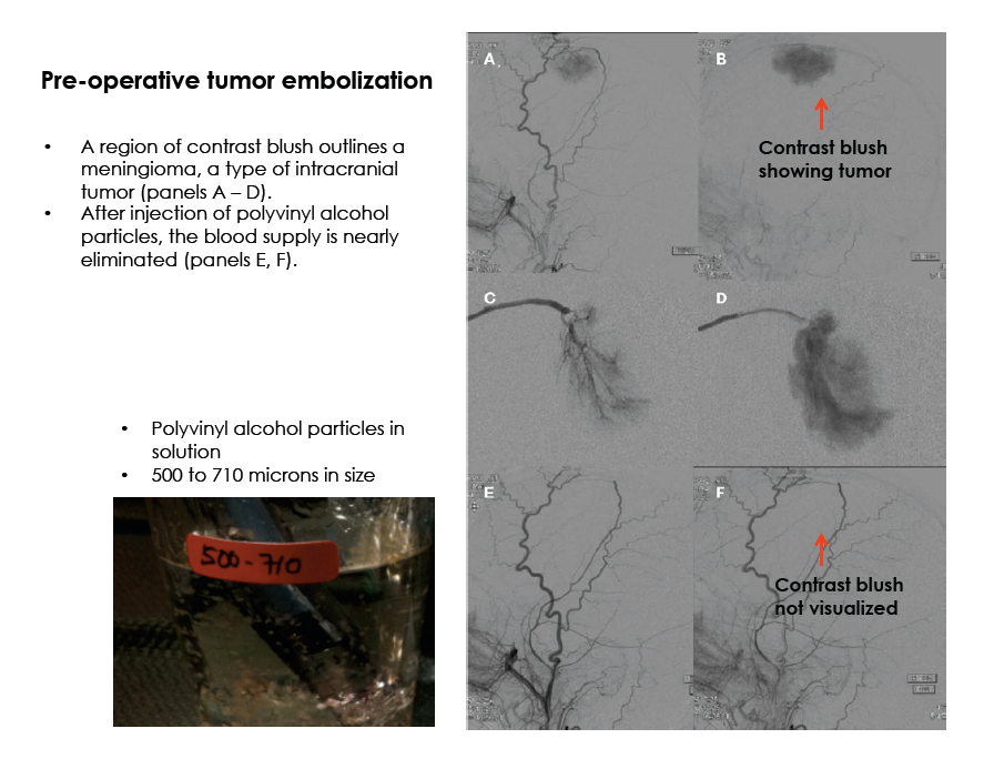 Preoperative Embolization of Head, Neck, and Spine Tumors