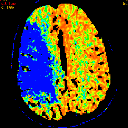 Acute Ischemic Stroke