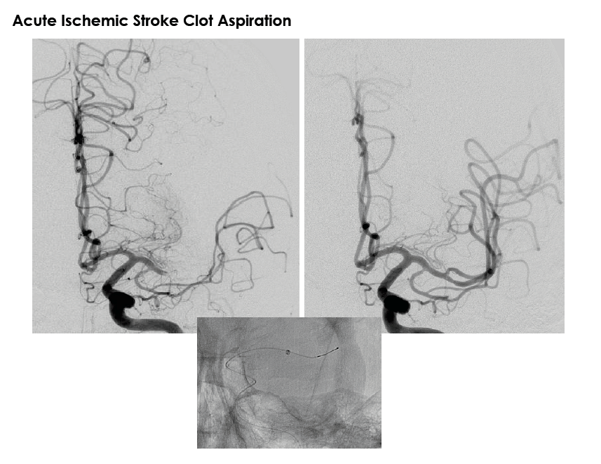 Acute Ischemic Stroke Clot Aspiration