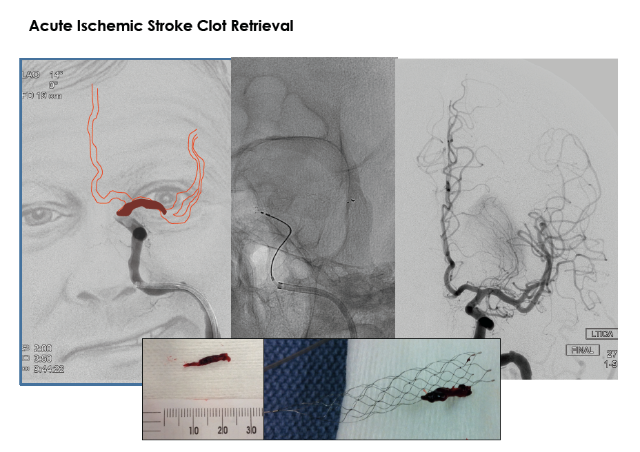 Acute Ischemic Stroke Clot Retrieval