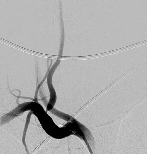 Vertebral Artery Stenosis