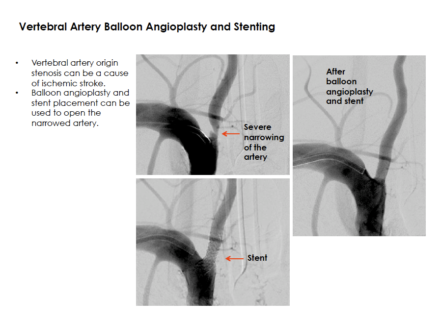 Vertebral Artery Balloon Angioplasty and Stenting