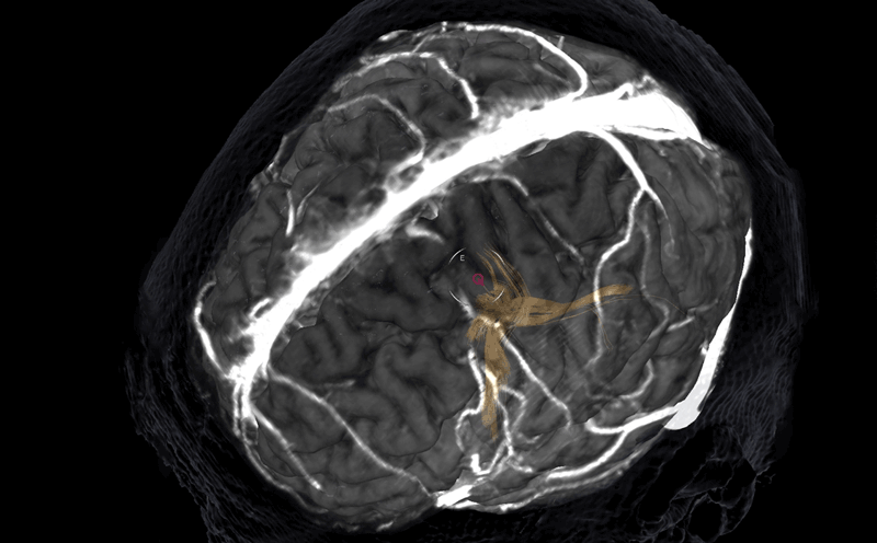 Three-dimensional imaging of brain, including targeted neural pathway highlighted in yellow, indicating focal epileptic event