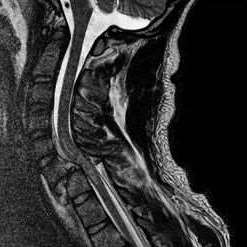 CT image of the neck in black and white