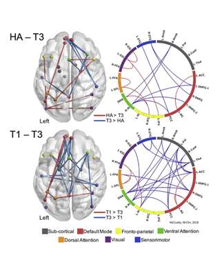 Neuroimaging Concussion