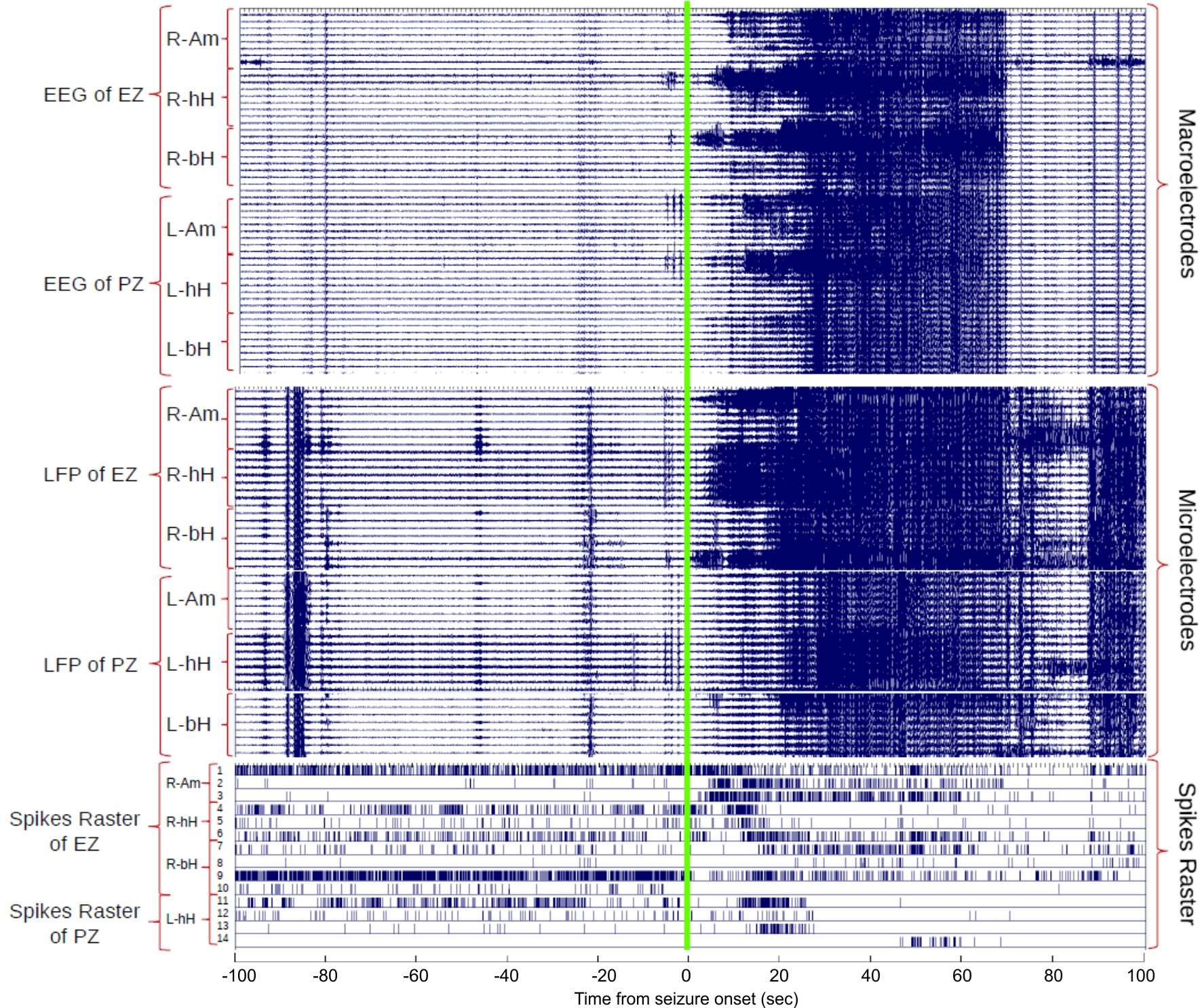 Multiscale simultaneous recordings of brain impulses during seizure