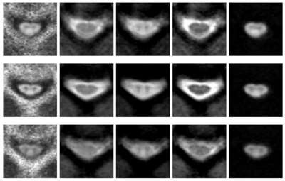 Degenerative Cervical Myelopathy Imaging