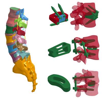 Whole and segmented model of lumbar spine with implants, including ALIF, PLIF and TLIF