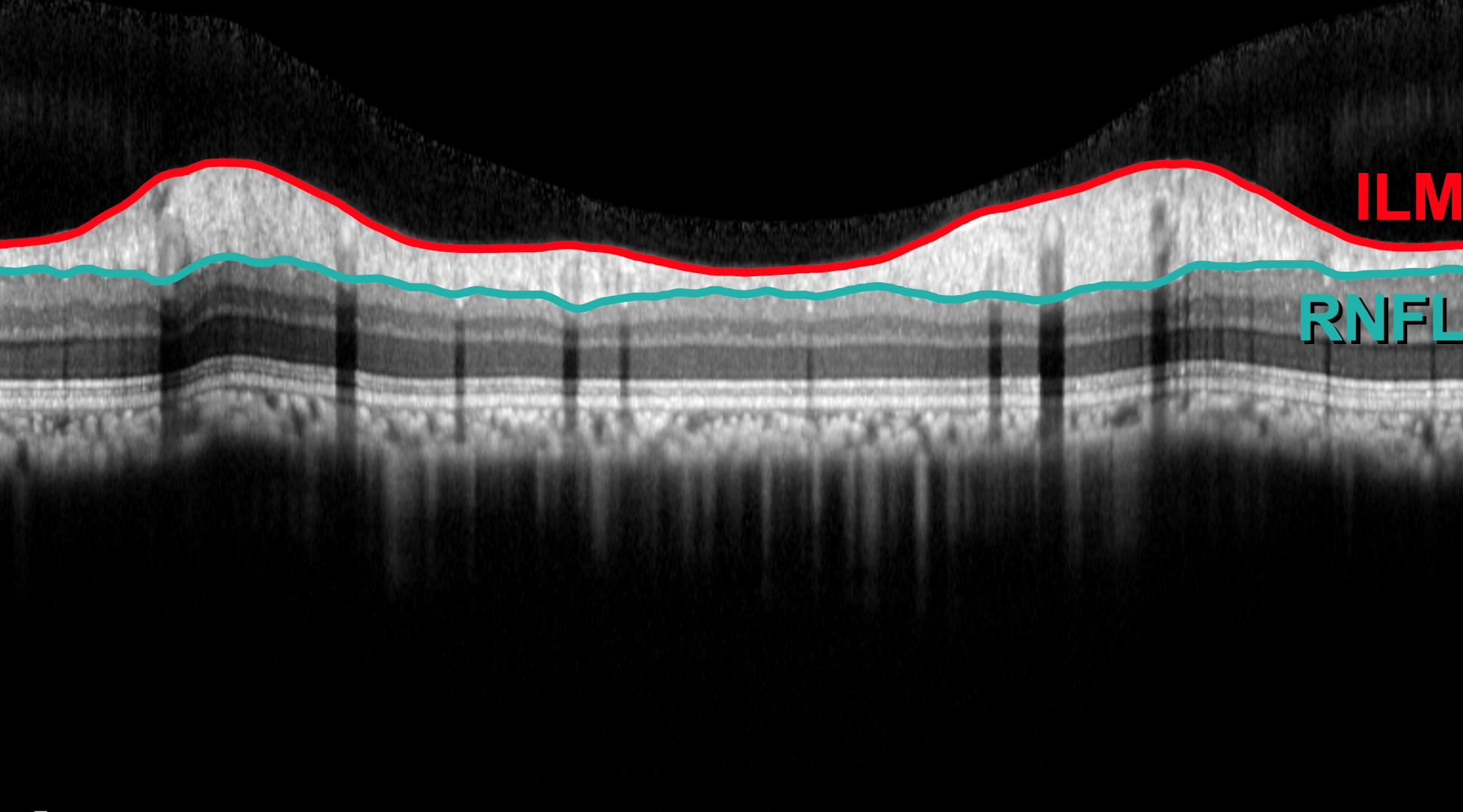 ResearchImage2_Glaucoma_Stacked Image Text Split Component