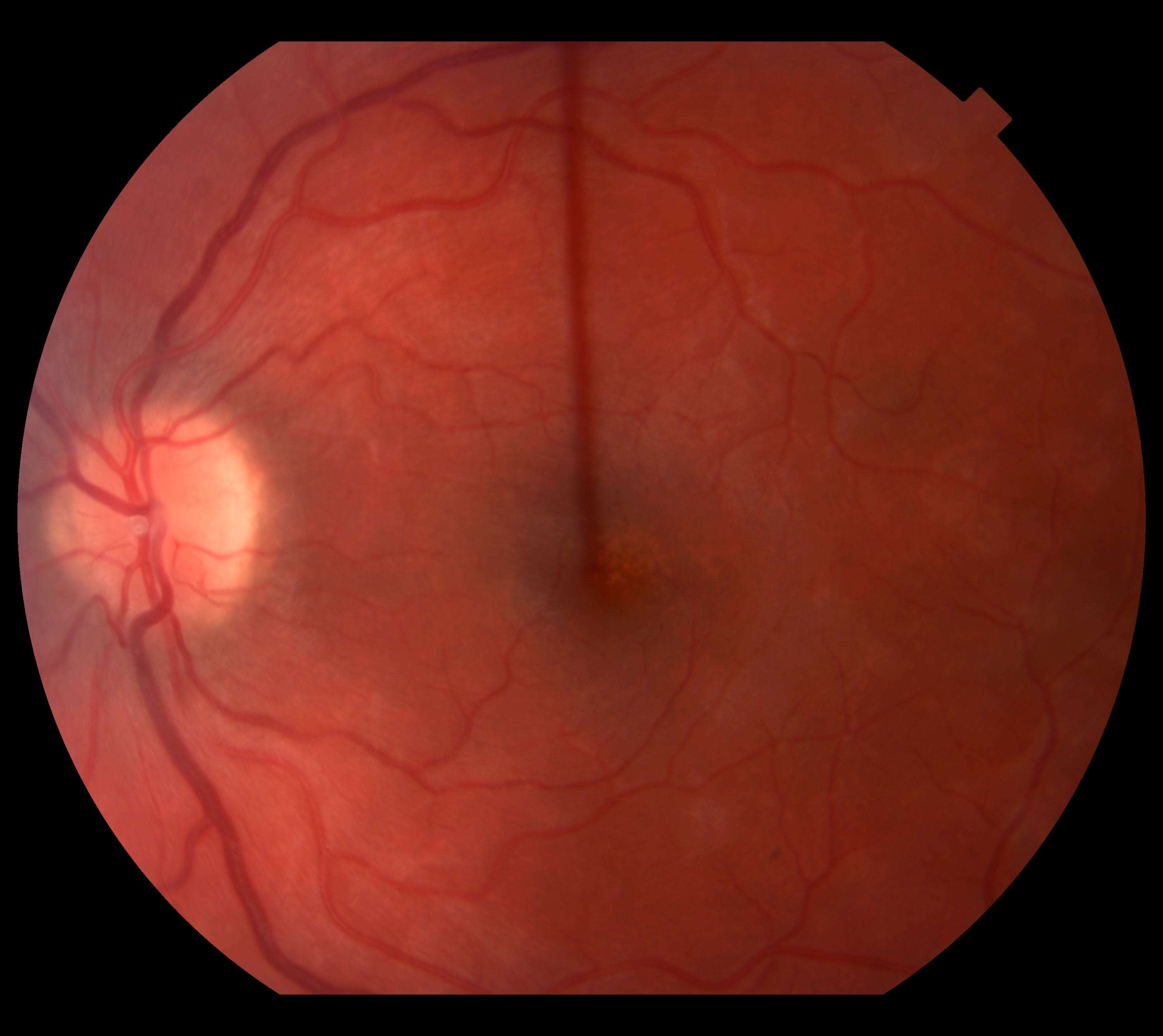 Case 1 macula