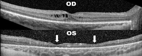 Case Study 21_OCT Image
