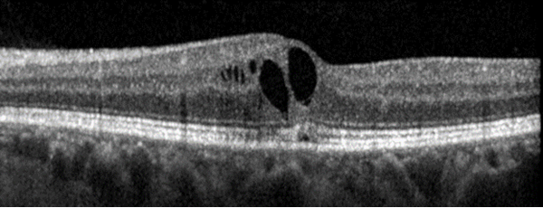 Case Study 26 Macular Hole 2 v2