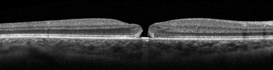 Case Study 26 Macular Hole v2