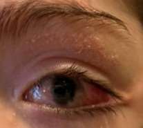 Retinoscopy OD