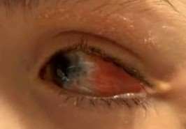 Retinoscopy OS