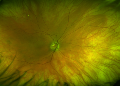 Case Study 19 Fundus Photo