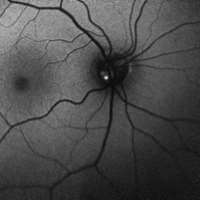 Fundus Autoflourescence OD OS_Left