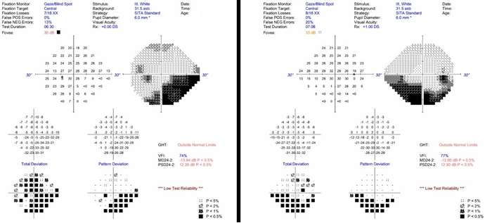 Humphrey Visual Fields