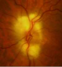Myelinated Retinal Nerve Fiber Layer