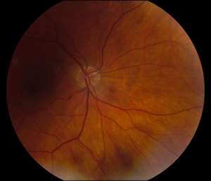 Optic Disc Photo OD OS_Left