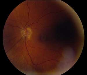 Optic Disc Photo OD OS_Right