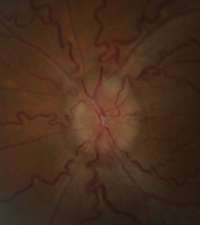 Pseudotumor Cerebri
