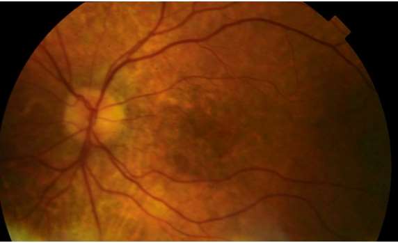 Quiz 4_Disc and Macula Left Eye