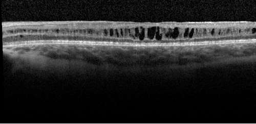 Quiz 6 Image 3_Macular SD-OCT showing schitic cavities in xlrs left eye