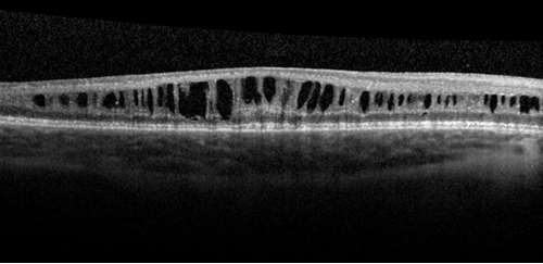 Quiz 6 Image 3_Macular SD-OCT showing schitic cavities in xlrs right eye