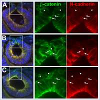 2020_Novel variants in CDH2