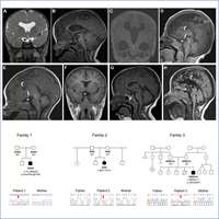 2022_Novel Genetic Diagnoses in Septo-Optic Dysplasia