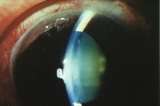 glaucomaexample1