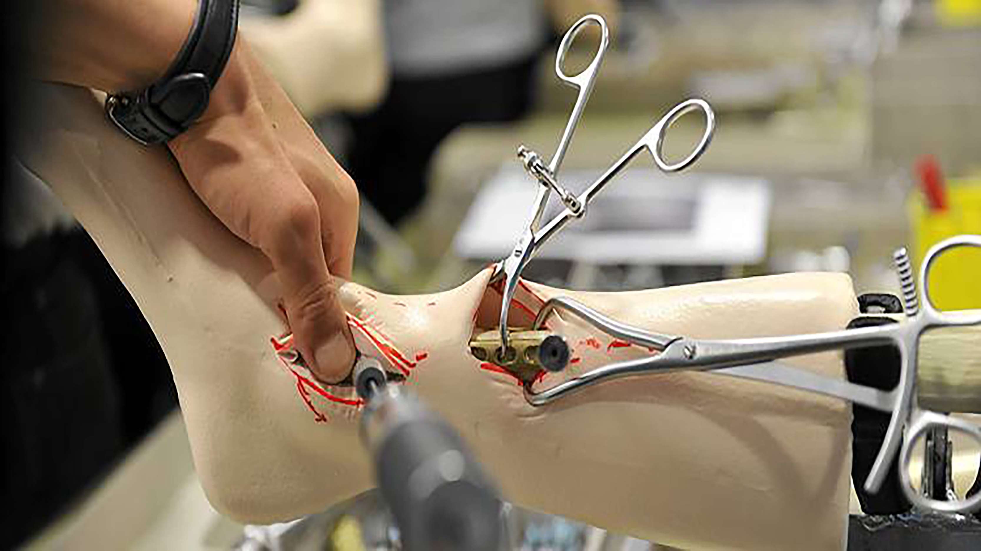 Orthopaedic Surgery Foot Fellowship_Image Text Split Component Orthopaedic Surgery Foot and Ankle Fellowship