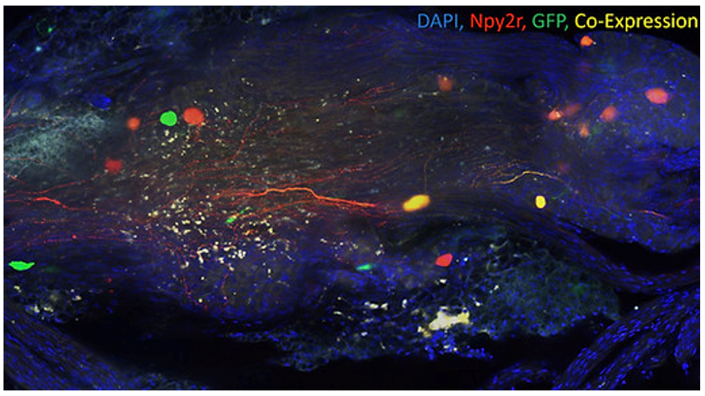 Vagal sensory neurons in chronic lung disease
