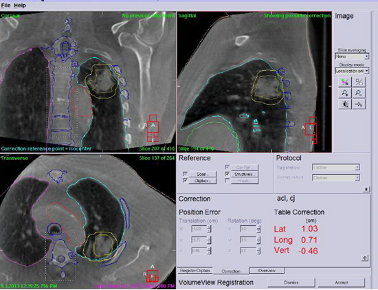 SBRT Scan