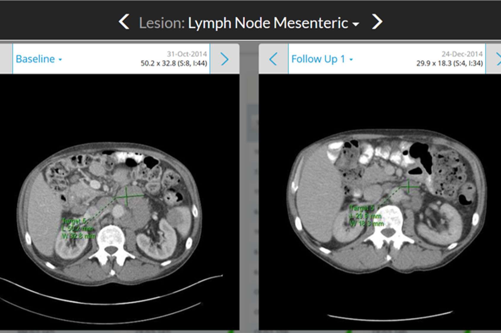 Measurements of Lymph Nodes