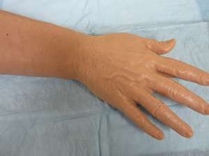 iv-arm-geriatric-white