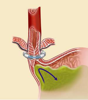 medical illustration of a LINX device and how it is supposed to work. 