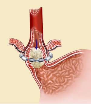 Picture showing Linx device in place allowing food passage into stomach.