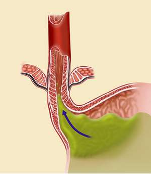 Picture of lower esophageal sphincter.