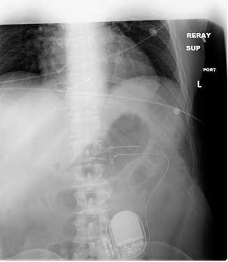 x-ray view of implanted gastric pacemaker