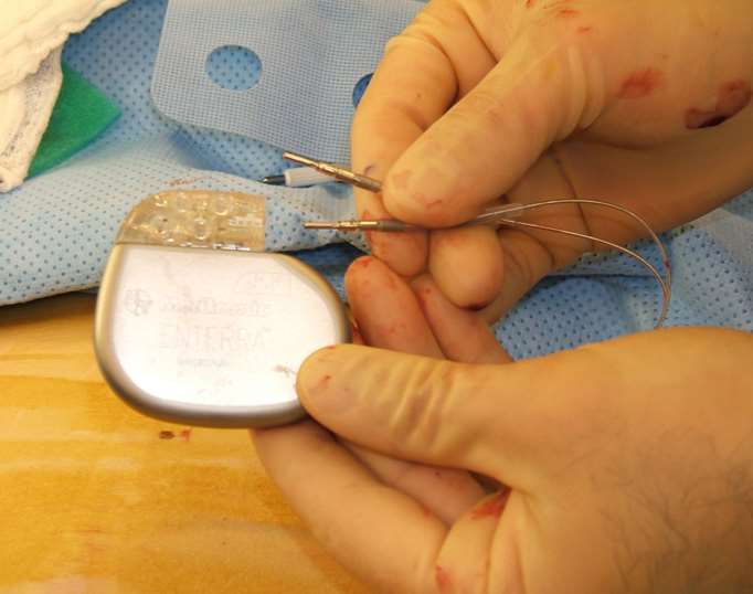 gastric pacemaker generator and leads