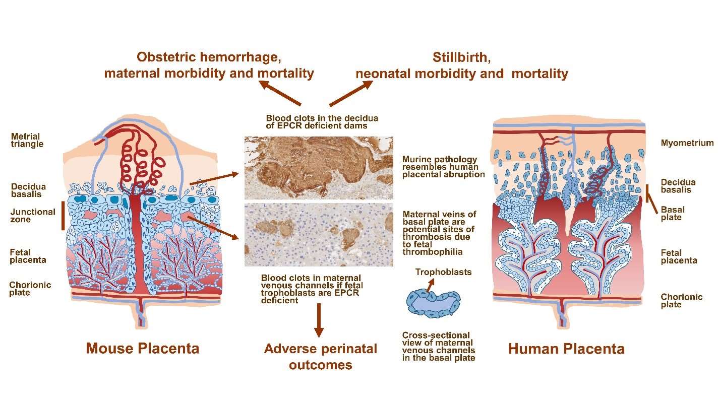 Study Reveals a Link Between Thrombophilia Placental Abruption and Obstetric Hemorrhage
