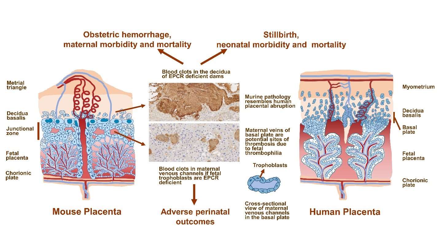 Study Reveals Link Between Thrombophilia, Placental Abruption & Obstetric  Hemorrhage, Press Release