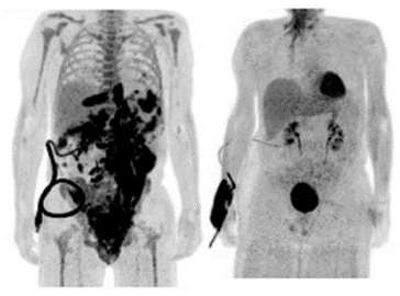 before and after body scans from car t cell therapy