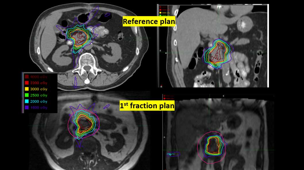 Pancreatic cancer treated with MR-guided ART
